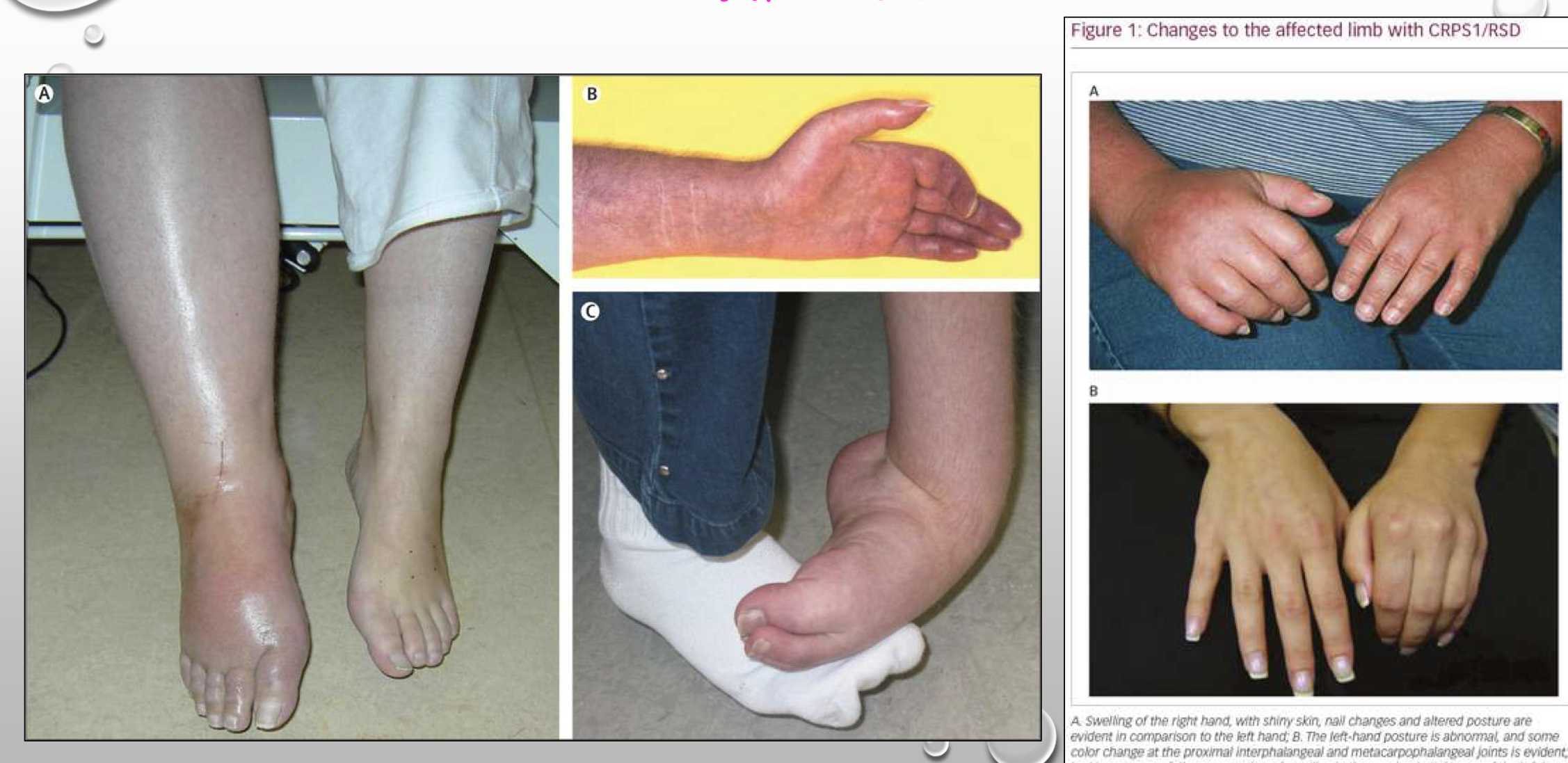 <p>Complex regional pain syndrome (CRPS) osteoporosis </p>