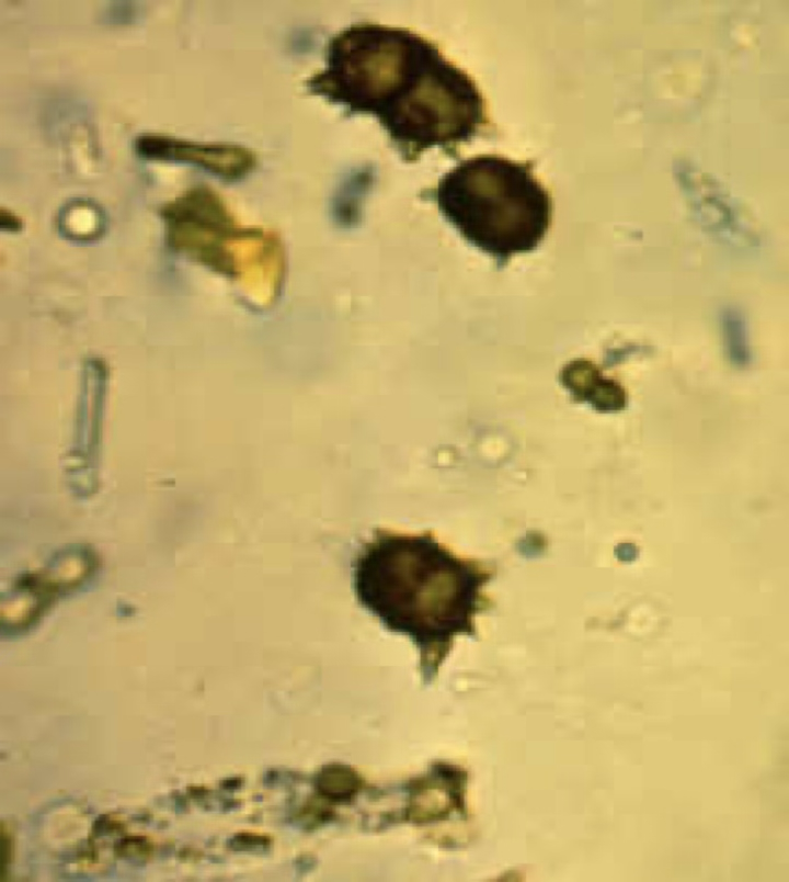 <ul><li><p>Typically seen in slightly acidic, alkaline, or neutral urine.</p></li><li><p>Resemble “thorn apples”.</p></li><li><p>Commonly seen in animals with severe disease, such as portacaval shunts.</p></li></ul><p></p>