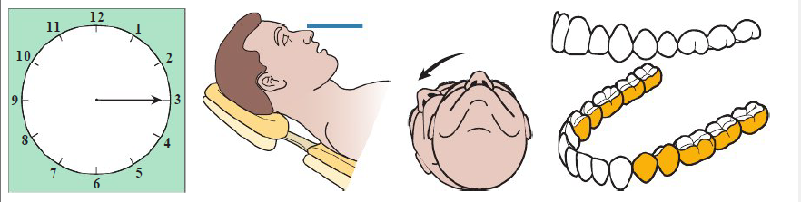 <ul><li><p>Clinician in 3 o’clock position</p></li><li><p>Chin down </p></li><li><p>Mandibular occlusal parallel to floor</p></li><li><p>Patient’s head: neutral or slightly away from clinician</p></li></ul><p></p>