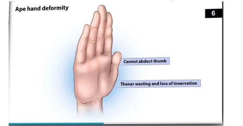 <p>Does not supply the FDS and FDP</p><ul><li><p>The terminal branch supplies the thenar eminence which will result in its atrophy due to wasting of muscles</p></li><li><p>Decreased sensation on area being supplied by the median nerve</p></li></ul><p></p><p>Presentation: Ape hand deformity, papal benediction</p><p></p>