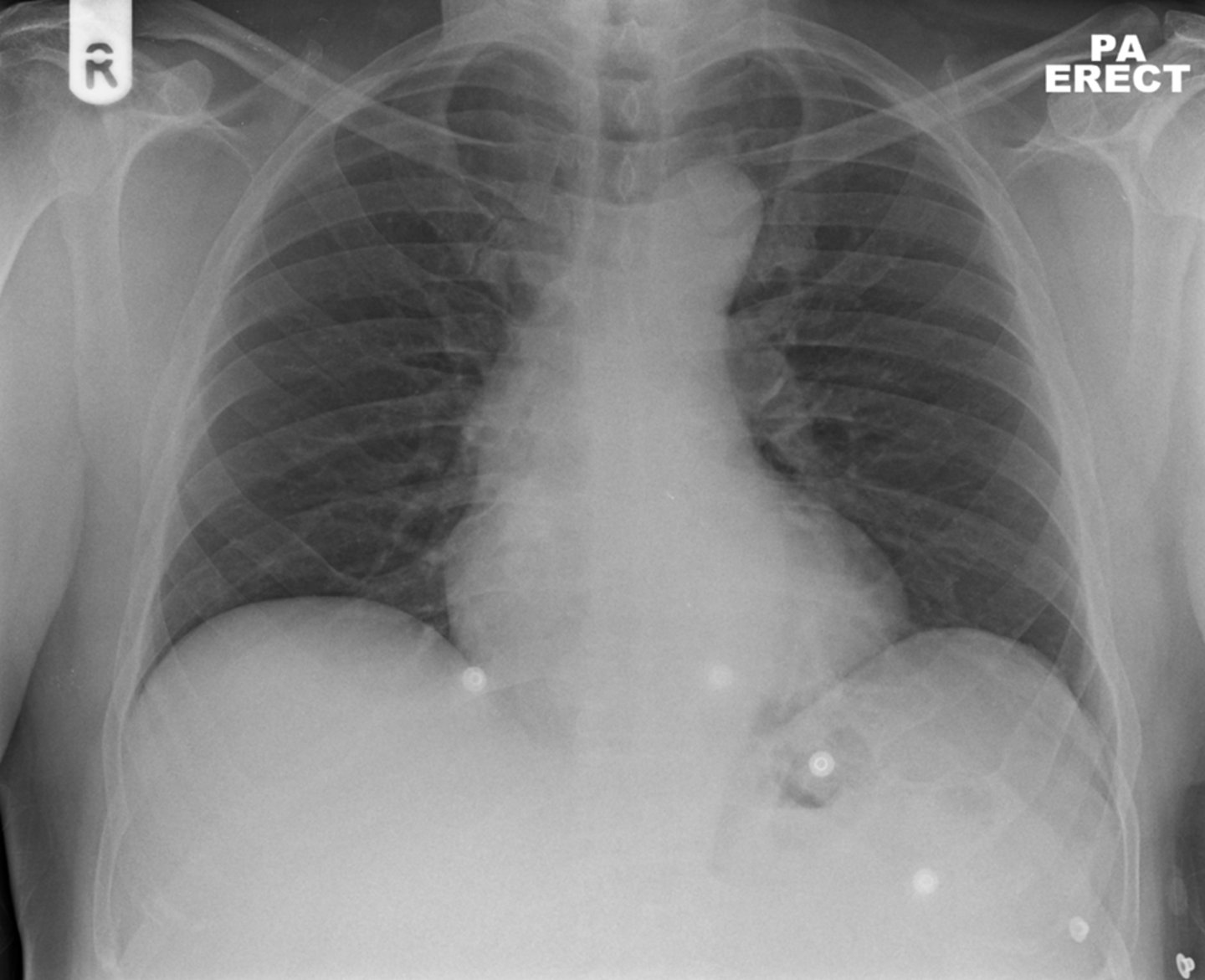 <p>Female. 65 years. Acute left sided chest pain</p>