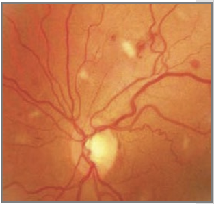 <ul><li><p>Low red blood cell count</p></li><li><p>May cause retinal hemorrhages</p></li><li><p>Systemic symptoms include:</p><ul><li><p>Lethargy</p></li><li><p>Pallor</p></li></ul></li></ul><p></p>