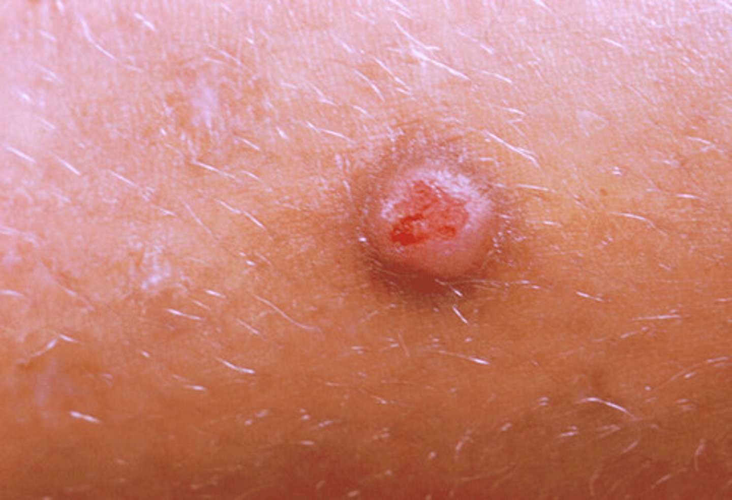 <p>Inflammatory acne lesion resulting from follicle wall rupture and infusion of blood</p>