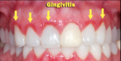 <p>a non-specific inflammatory lesion resulting from interactions between dental plaque and the host's immune-inflammatory response. Reversible, contained within the gingiva.</p>