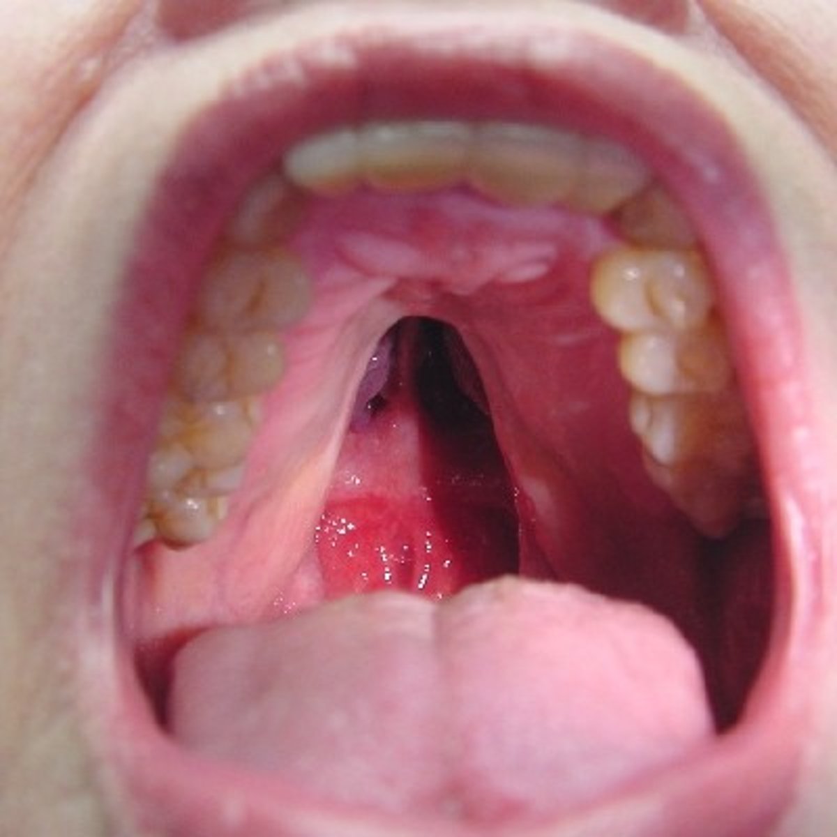 <p>Require surgical correction. A bifid uvula may be associated with a submucosal cleft palate</p>