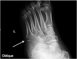 <p>ligament tears off a small part of bone</p>