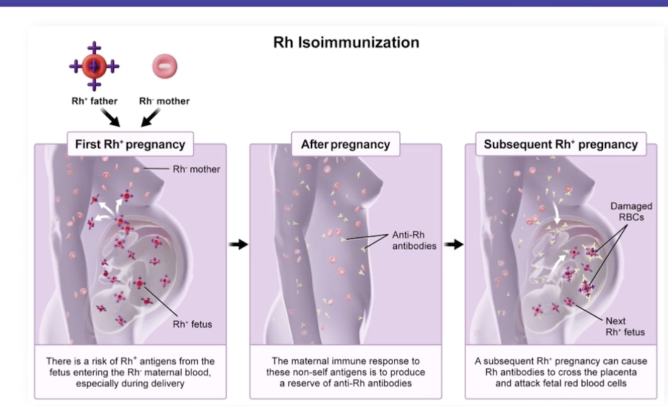<p>Disorder initiated by a Rh (-) mother carrying an Rh (+) fetus, becomes problematic upon a second pregnancy with another Rh (+) fetus</p>