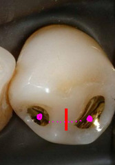 <p>Mandibular first premolars might not have central grooves because of how prominent what ridges are?</p>