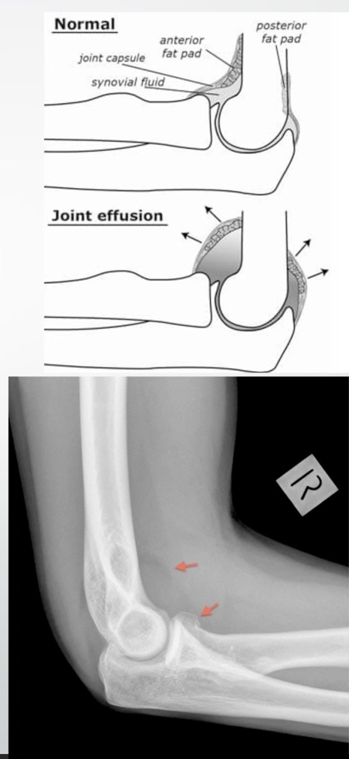 <ul><li><p><span>Raised anterior and/or posterior fat pad on an elbow radiograph</span></p></li><li><p><span>Indicates joint effusion, possible fracture</span></p></li></ul><p></p>