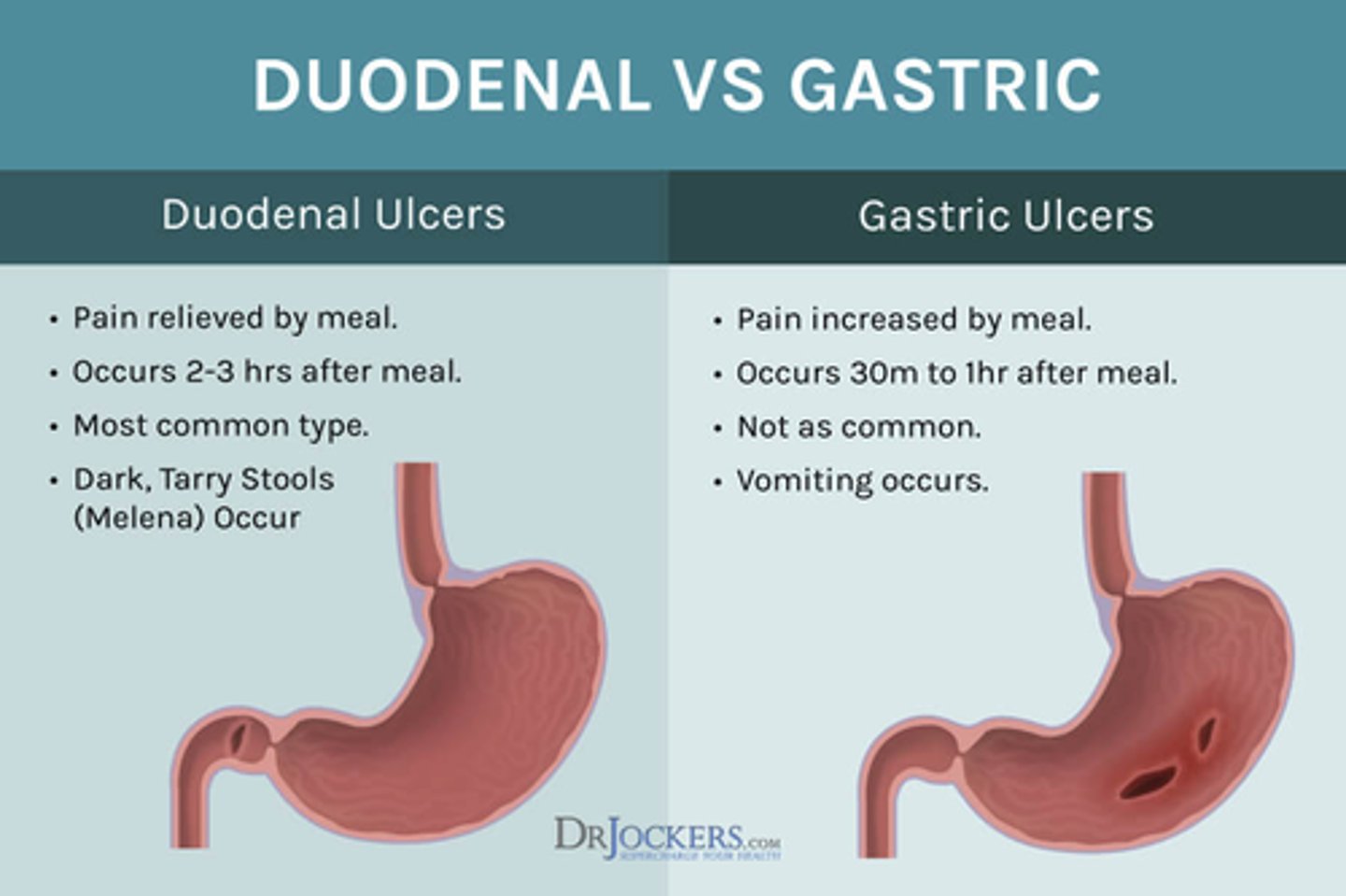 <p>B) Burning/aching pain immediately after drinking = gastric ulcer; Burning/aching pain 2-3 hours after eating = duodenal ulcer</p>