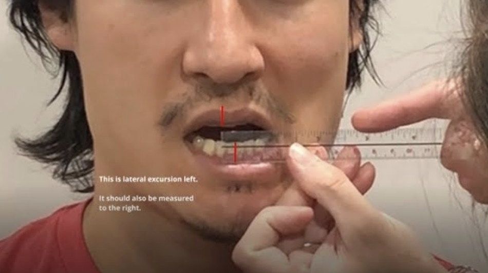 <p>• Linear distance between the center of the upper incisors and the center of the lower incisors in millimeters. </p><p>• Typically ranges from 8 to 12 mm to each side.</p>