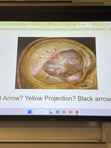 <p>Black: t</p><p>The hole near the black arrow will eventually lead to: foramen magnum, but before that, under that layer = </p><p>Yellow: </p><p>Red: </p><p></p>
