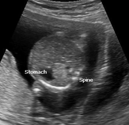 <p>Echogenic, triangular-shaped mass within the fetal chest</p><p>Pleural effusion may be present</p>