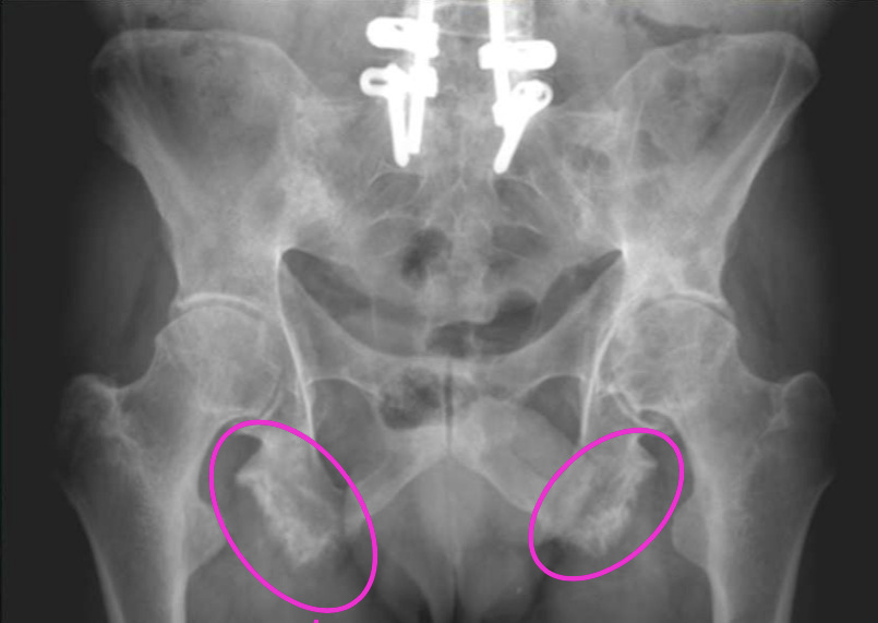 <p>What finding of AS is found in this image</p>