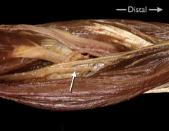 <p>In this lateral view of the right elbow and forearm, identify the nerve indicated by the arrow.</p>