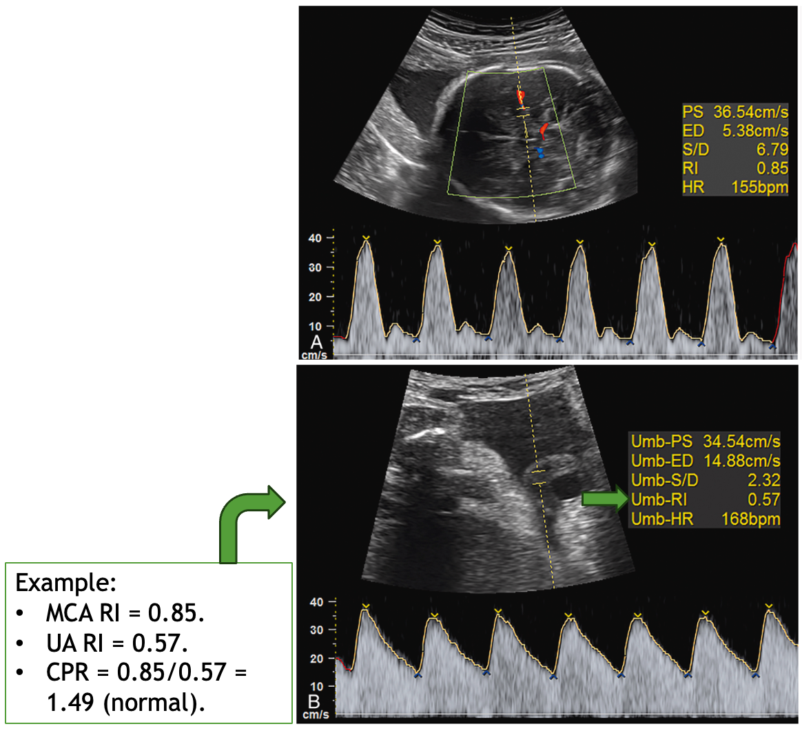 <p>cerebroplacental ratio (CPR)</p>