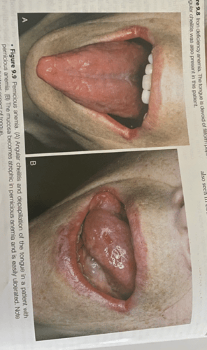 <p><br><span>-Vitamin B12 deficiency that is caused by a deficiency of intrinsic factors a substance secreted by the parietal cells of the stomach</span></p>