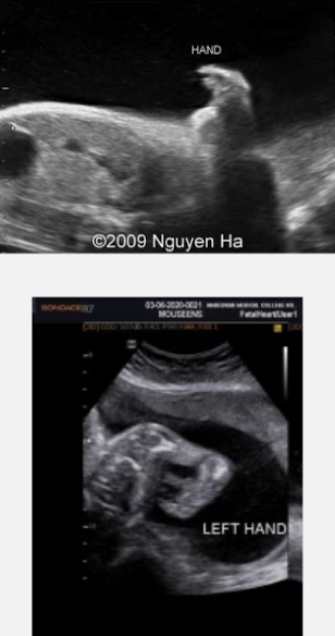 <ul><li><p>phocomelia</p><ul><li><p>absent or severely shortened limbs</p></li><li><p>MC in upper extremities</p></li></ul></li><li><p>bilateral cleft lip and palate</p></li><li><p>hypertelorism</p></li><li><p>microcephaly</p></li><li><p>cardiac, renal, and GI anomalies (possibly)</p></li></ul><p></p>