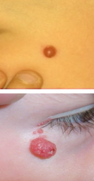 <p>spitz nevus</p>