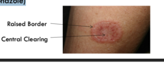 <p>ringworm</p><p>well demarcated annular plaque with central clearing and peripheral scale </p><p>contagious </p><p>diagnosis</p><p>KOH prep (optional) </p><p>topical treatment</p><p>-azoles (econazole, ketoconazole)</p>