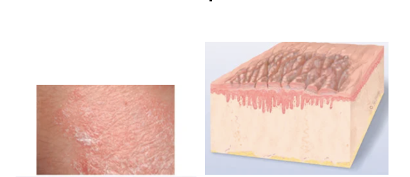 <p><span>Prolonged, intense scratching that thickens skin and produces tightly packed sets of papules (looks like surface of moss or lichen)</span></p>