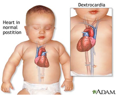 <p>When heart is on opposite side of the body</p>
