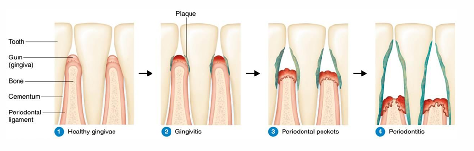 <ol><li><p>Healthy gingivae</p></li><li><p>Gingivitis → Inflammation and infection of the gums</p></li><li><p>Periodontal pockets → Bone and tissue supporting the teeth are destroyed</p></li><li><p>Periodontitis</p></li></ol><p></p>
