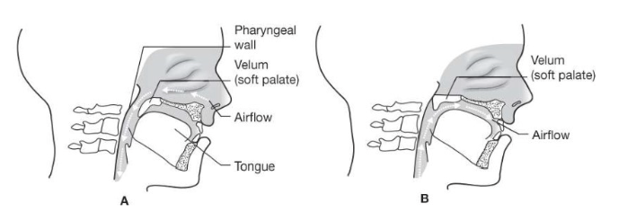 <ul><li><p>coordinated movement of the following structures</p></li></ul><p>velum (soft palate)</p><p>lateral pharyngeal walls</p><p>posterior pharyngeal wall</p><p></p>