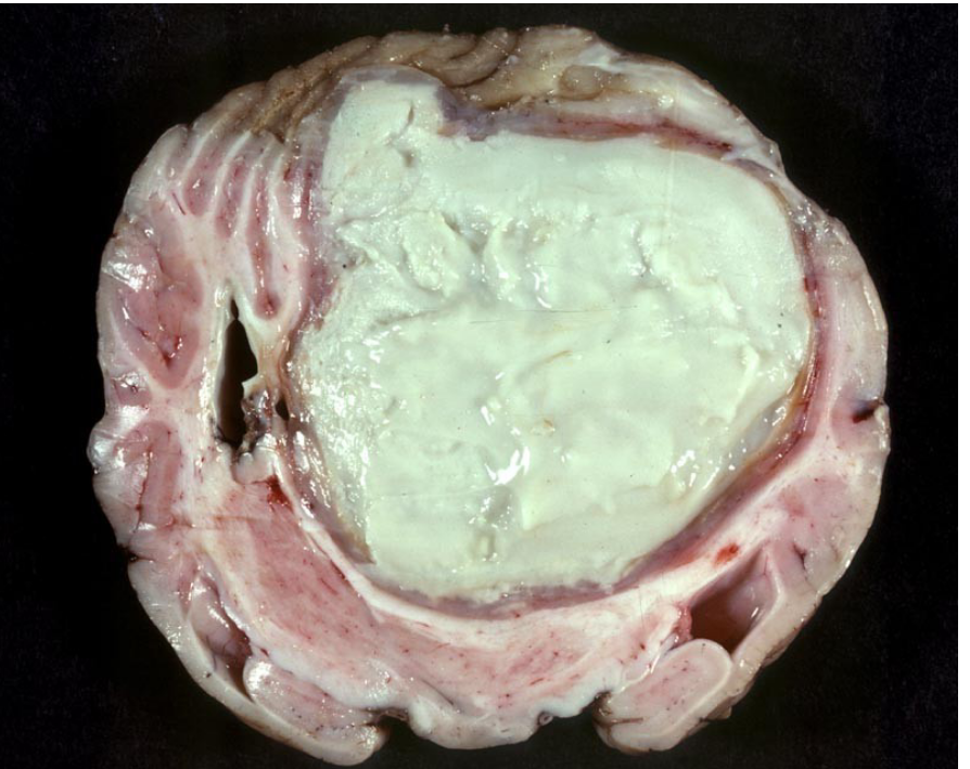 <p>liquefication necrosis</p>
