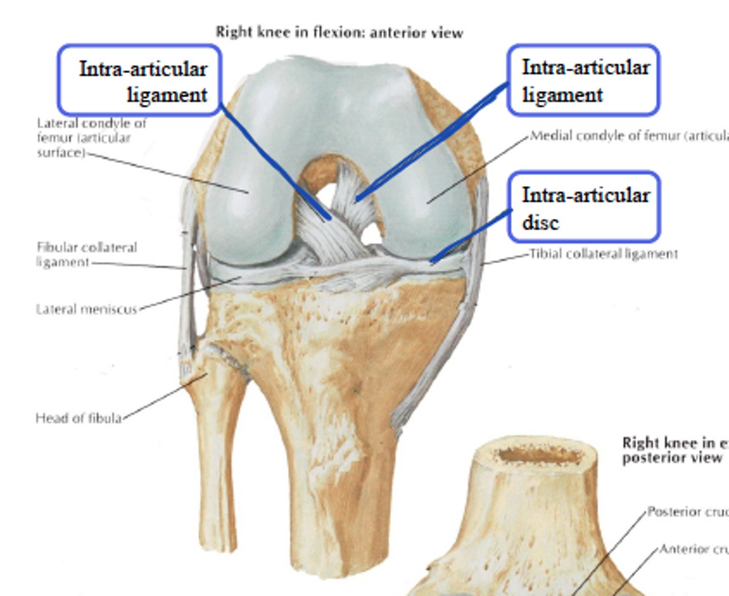 <p>meniscus; a fibrocartilage structure found between the bones of some synovial joints; provides padding or smooths movements between the bones; strongly unites the bones together</p>