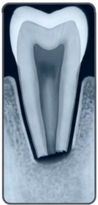 <p><strong>aka: </strong>ankylosis</p><p>Gradual elimination of apical root dentin with preservation of the PDL. Mimics early natural exfoliation.</p><p>Results after irreversible injury to the PDL</p><p>Alveolar bone directly contacts and fuses with the root surface</p>