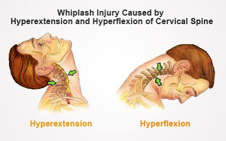 <p>moving a joint <strong>too far</strong> past its normal limit</p><ul><li><p>detail: moving it past the <em>anatomical position</em>. they are a common cause of injury in the joints like the <em>knee or elbow</em></p></li><li><p>example: looking up at the stars hyperextends the neck</p></li></ul><p></p>