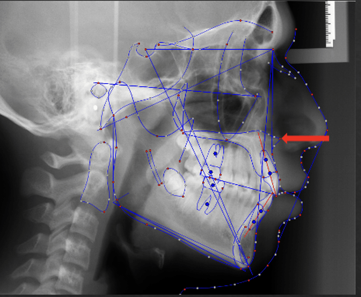 <p>which anatomical landmark:</p><p>- The tip of the anterior nasal spine</p>