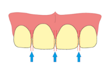 <p>Surface between the 2 adjacent teeth </p>