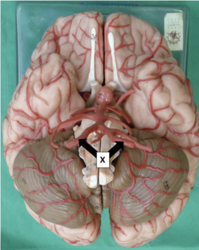 <p><span>The vessels labelled X enter the cranial cavity through the:</span></p>
