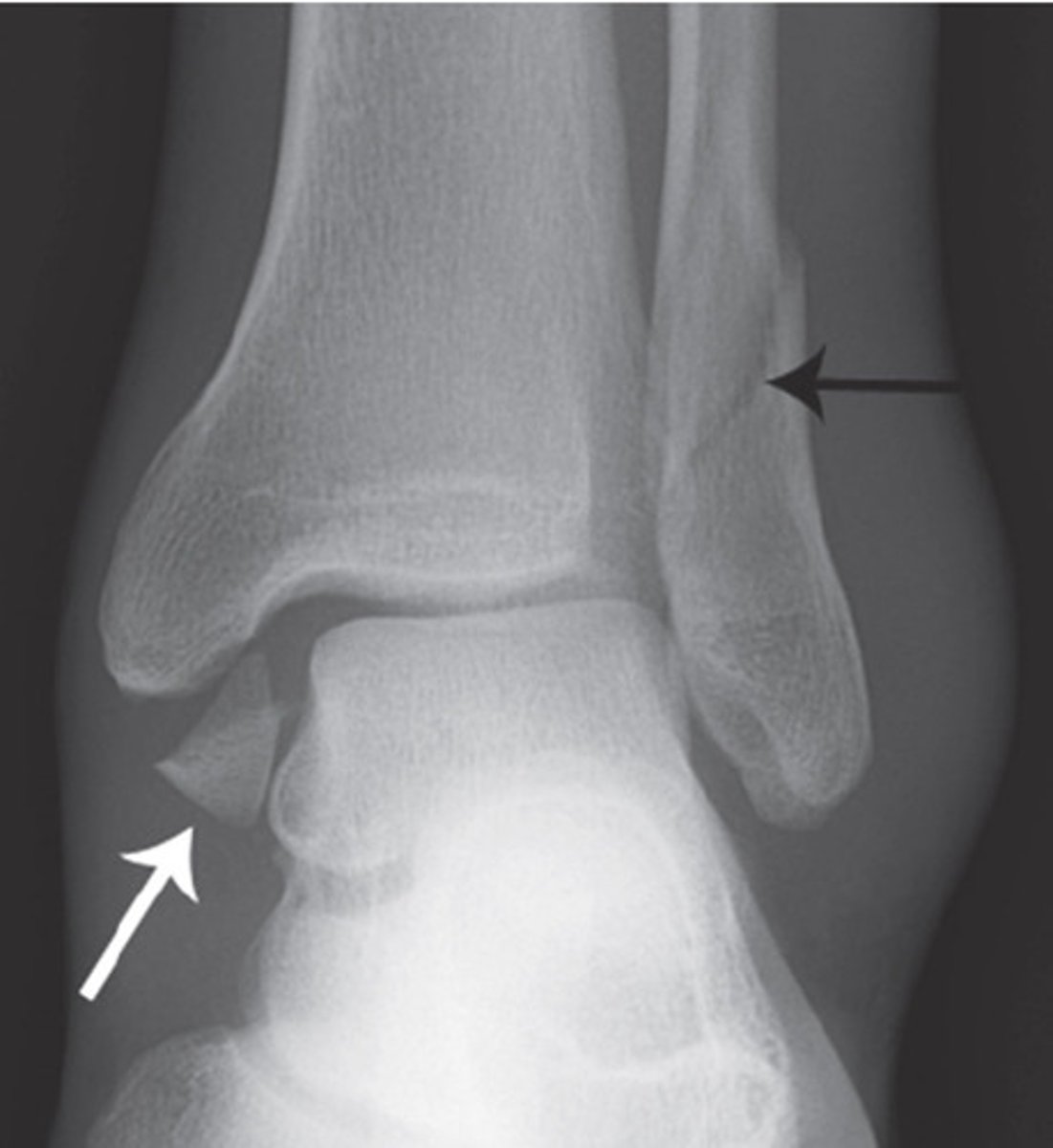 <p>Bony injury where a tendon or ligament attaches</p>