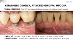 <p>- Shallow vestibules</p><p>- Pull on gingival margin</p>