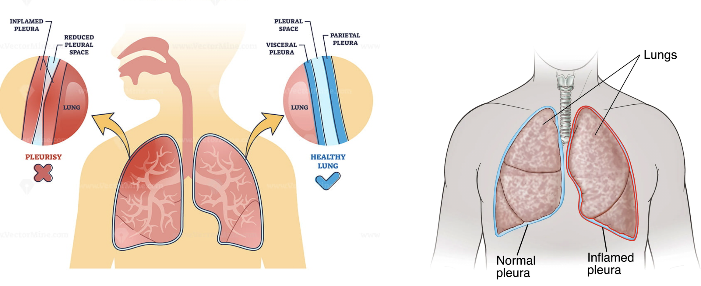 <p>inflammation of the pleura </p>