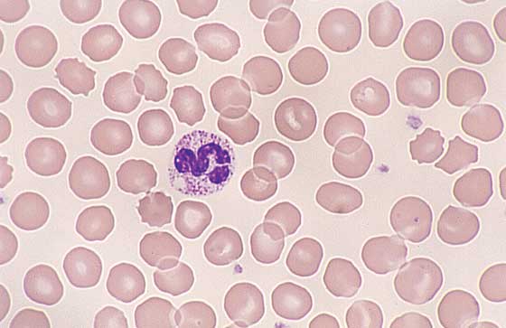 <p>Increase in cytoplasmic basophilia, bigger, toxic granulation, <mark data-color="rgba(0, 0, 0, 0)" style="background-color: rgba(0, 0, 0, 0); color: inherit;">prolonged cell life</mark><span>, often linked to severe chronic inflammation or infection,</span></p>