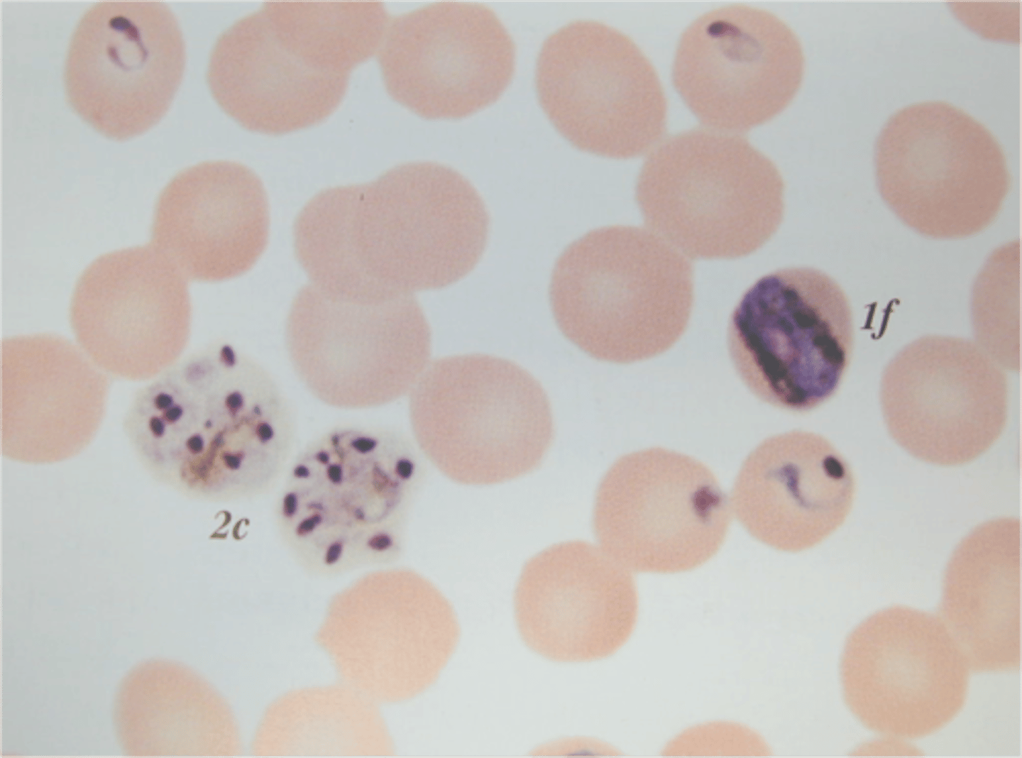 <p>A protist infectious disease that affects animals.</p><p>- Parasite that causes headaches and fever, possibly leading to coma and death</p><p>- Diagnosed through observation of symptoms / blood tests</p><p>- Treated with chloroquine phosphate, ACT's and antimalarial drugs</p><p>- Uses mosquitoes as vector</p><p>- Disease of poverty</p><p>- Targets liver cells (hepatocytes) and bursts them</p><p>- Then targets erythrocytes and bursts them, leading to lack of oxygen and fatigue</p>