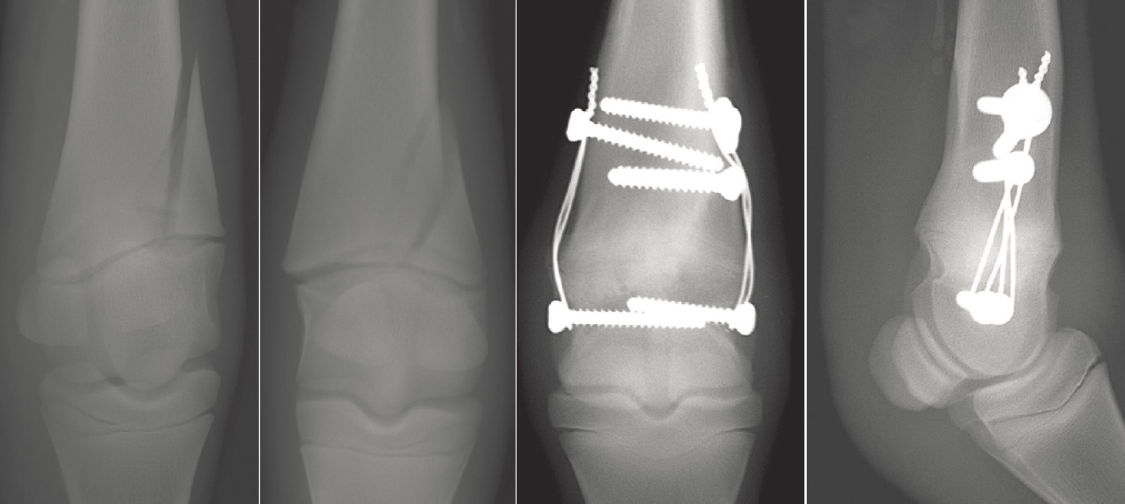 <p>What type of fracture is being shown</p>