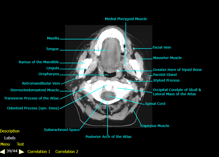 <ol><li><p>Subarachnoid Space</p></li><li><p>Posterior Arch of the Atlas</p></li><li><p>Trapezius muscle</p></li><li><p>Spinal Cord</p></li><li><p>Occipital Condyle of the skull and the lateral mass of the atlas</p></li><li><p>Styloid Process</p></li><li><p>Parotid Gland</p></li><li><p>Greater horn of the hyoid bone</p></li><li><p>Masseter Muscle</p></li><li><p>Facial Vein</p></li><li><p>Medial Pterygoid Muscle</p></li><li><p>Maxilla</p></li><li><p>Tongue</p></li><li><p>Ramus of the Mandible</p></li><li><p>Lingula</p></li><li><p>Oropharynx</p></li><li><p>Retromandibular Vein</p></li><li><p>Sternocleidomastoid muscle</p></li><li><p>Transverse process of the Atlas</p></li><li><p>Odontoid Process</p></li></ol><p></p>