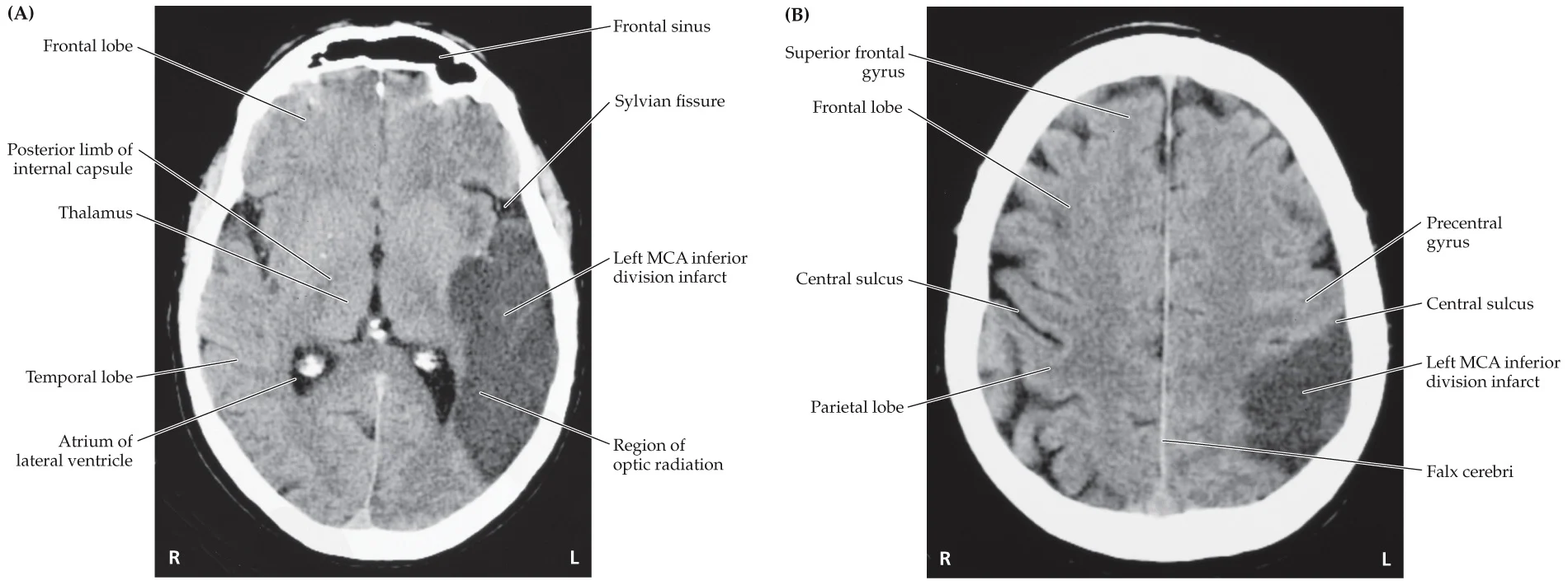 <p>Left MCA inferior division</p>