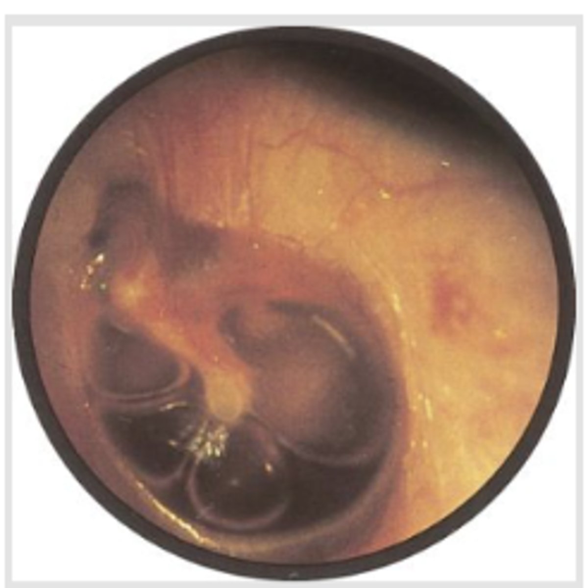 <p>usually caused by viral upper respiratory infections (otitis media with serous effusion) or by sudden changes in atmospheric pressure as from flying or diving</p><p>Symptoms include fullness and popping sensations in the ear, mild conduction hearing loss, and, sometimes, pain.</p>
