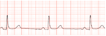 <ul><li><p class="Paragraph SCXW208897522 BCX8" style="text-align: left;"><span style="line-height: 20.85px;">Causes: Occurs in response to, Carotid sinus massage, Hypothermia, Increased Intraocular pressure, increased vagal tone, Administration of B-adrenergic, blockers, calcium channel Blockers, occurs in disease states, Hypothyroidism, Increased intracranial pressure, Inferior wall MI </span></p></li></ul><ul><li><p class="Paragraph SCXW208897522 BCX8" style="text-align: left;"><span style="line-height: 20.85px;">Tx: Atropine, dopamine, or epinephrine Pacemaker may be required </span></p></li></ul><p></p>