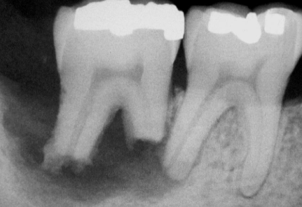 <p>Radiographic Adjacent Structures : the apex of the tooth appears shortened or blunted and irregularly shaped; occurs as a response to stimuli, which can include a cyst, tumor, trauma, malignancy</p>