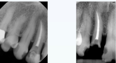 <p>At least 4 to 5 mm of apical gutta-percha must be retained.</p>