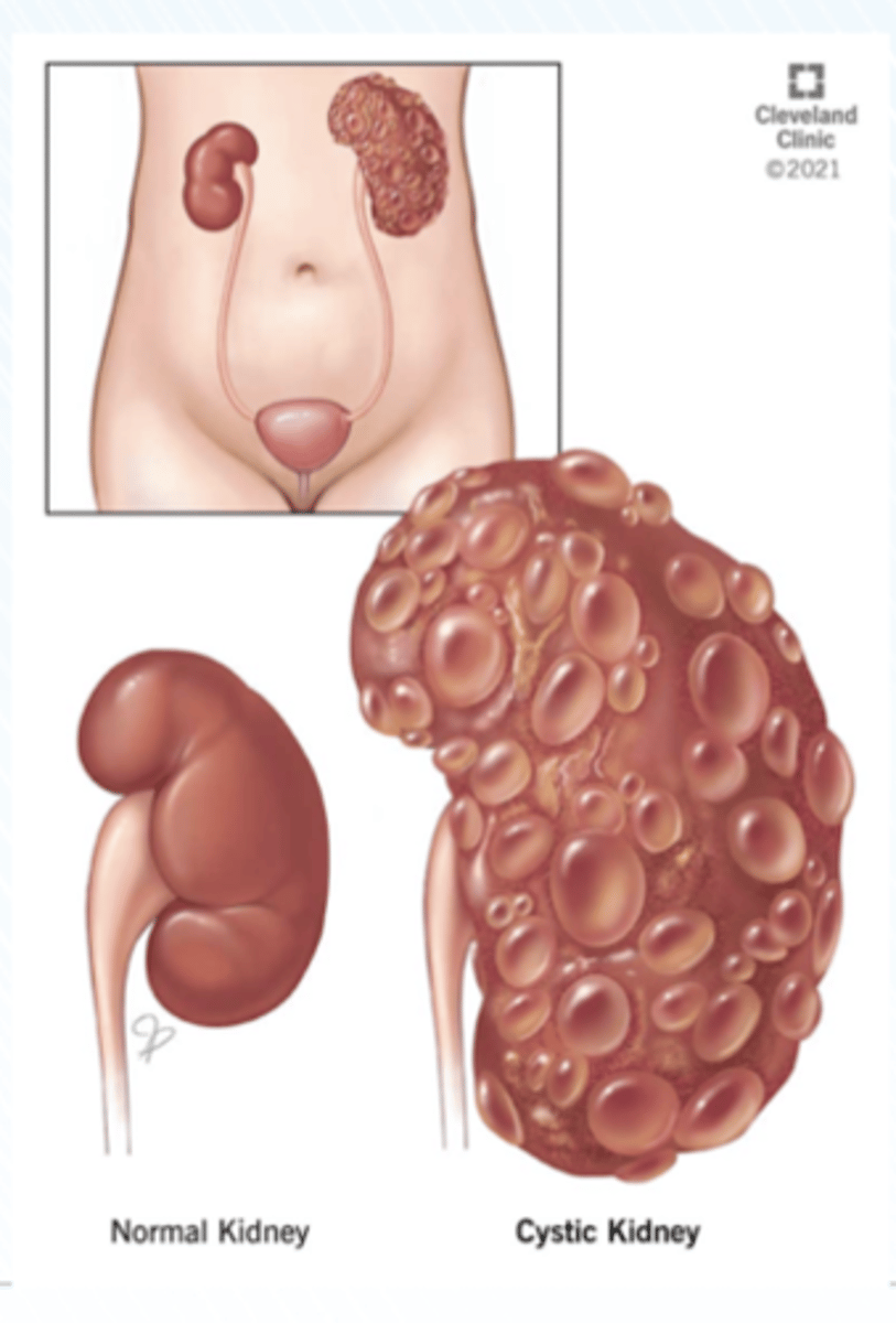 <p>1. Polycystic kidney disease (PKD)</p><p>2. Single cysts</p><p>3. Acquired cystic disease</p><p>4. Cystic diseases of the renal medulla</p><p>5. Cystic renal dysplasia</p>