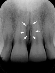 <p>Radiolucent area between maxillary central incisors</p>