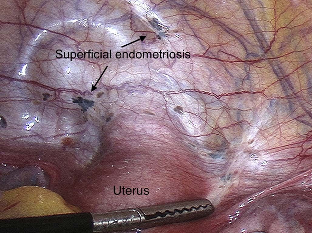 <p>endometriosis appearance*</p>